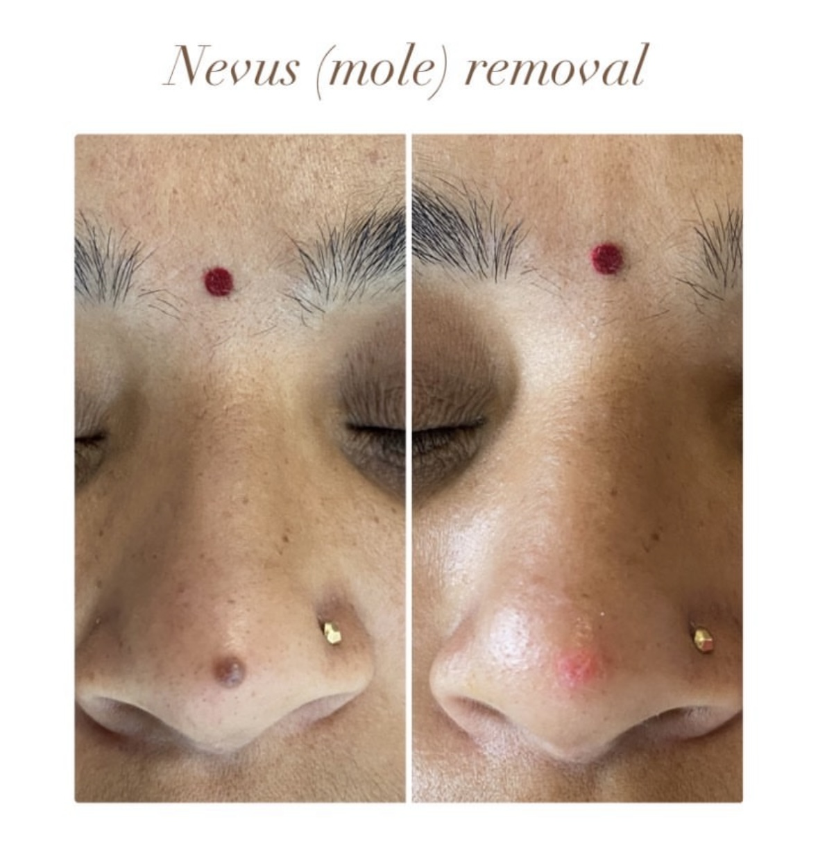 Hair Loss (Alopecia)